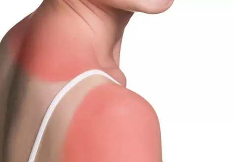 晒伤后皮肤发红几天能好(皮肤晒伤发红多久恢复) 晒伤后皮肤发红几天能好(皮肤晒伤发红多久恢复)