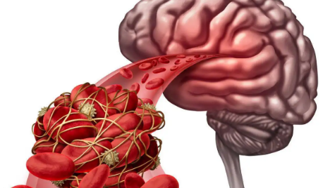 脑梗拍打三天见奇效真的假的