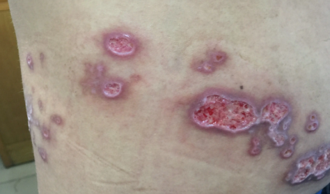 带状疱疹花了8000正常吗(治疗带状疱疹需要几千吗) 带状疱疹花了8000正常吗(治疗带状疱疹需要几千吗)