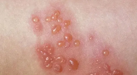 带状疱疹已经一周了还会传染正常吗(带状疱疹好了多久不会传染)