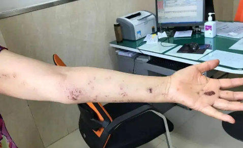 无缘无故怎么会得疱疹(无缘无故怎么会得带状疱疹) 无缘无故怎么会得疱疹(无缘无故怎么会得带状疱疹)