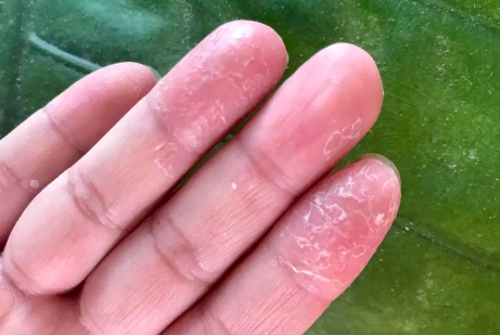 手脱皮还痒是怎么回事(手脱皮又痒是怎么回事)