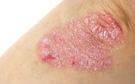 带状疱疹花了8000正常吗(治疗带状疱疹需要几千吗)