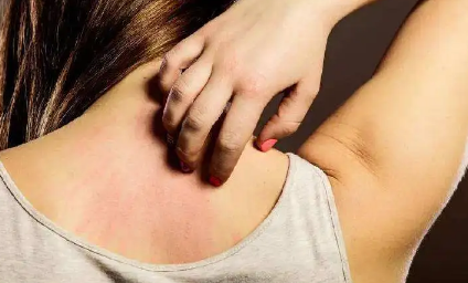 背部长痤疮会痒吗(背部长痘是痤疮吗) 背部长痤疮会痒吗(背部长痘是痤疮吗)