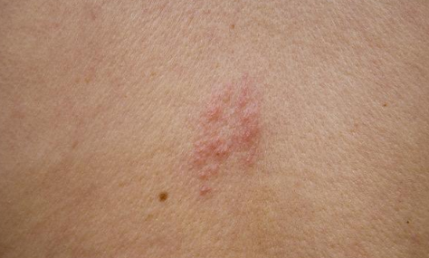 带状疱疹已经一周了还会传染正常吗(带状疱疹好了多久不会传染)