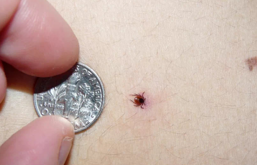 被蜱虫叮咬不要用火烫吗(蜱虫怕烫吗)