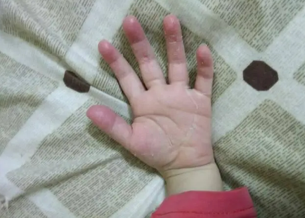 手脱皮还痒是怎么回事(手脱皮又痒是怎么回事)
