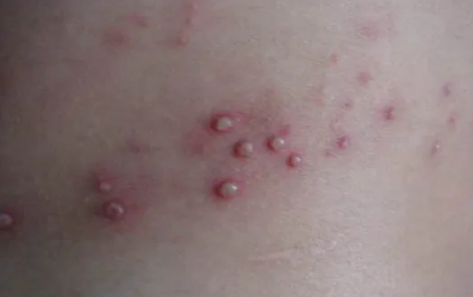 为什么说蛇缠腰是癌症(缠腰蛇是什么癌症引起的) 为什么说蛇缠腰是癌症(缠腰蛇是什么癌症引起的)