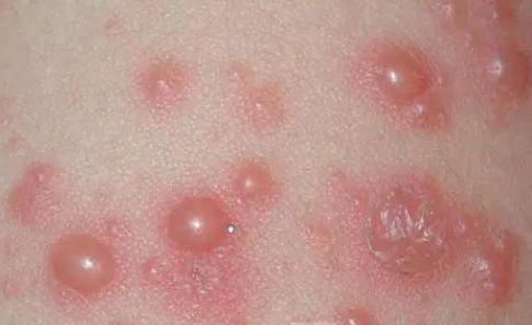 单纯疱疹一辈子都不能康复吗(单纯疱疹好了以后)