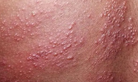 疱疹刚开始症状图片(疱疹刚开始症状图片私处)