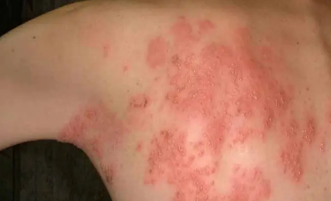 疱疹刚开始症状图片(疱疹刚开始症状图片私处)