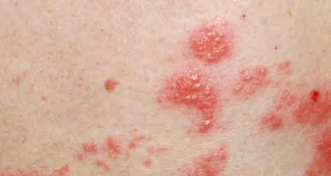 带状疱疹花了8000正常吗(治疗带状疱疹需要几千吗) 带状疱疹花了8000正常吗(治疗带状疱疹需要几千吗)