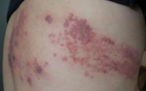 带状疱疹已经一周了还会传染正常吗(带状疱疹好了多久不会传染)