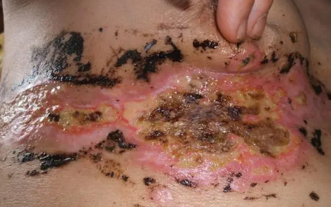 疱疹刚开始症状图片(疱疹刚开始症状图片私处)