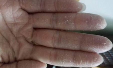 手脱皮还痒是怎么回事(手脱皮又痒是怎么回事)