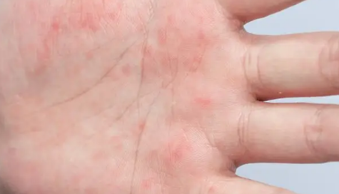 为什么说蛇缠腰是癌症(缠腰蛇是什么癌症引起的) 为什么说蛇缠腰是癌症(缠腰蛇是什么癌症引起的)