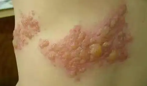 无缘无故怎么会得疱疹(无缘无故怎么会得带状疱疹) 无缘无故怎么会得疱疹(无缘无故怎么会得带状疱疹)