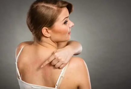 背部长痤疮会痒吗(背部长痘是痤疮吗)