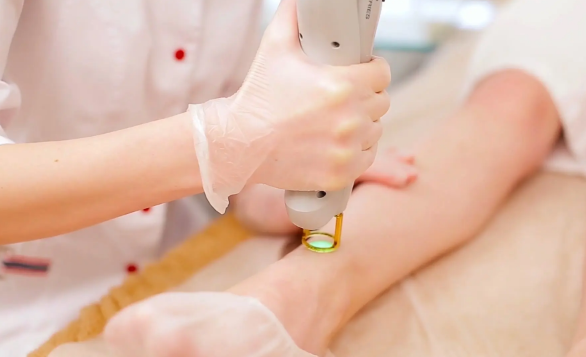 激光脱毛会引起狐臭吗(激光脱毛会不会得狐臭)