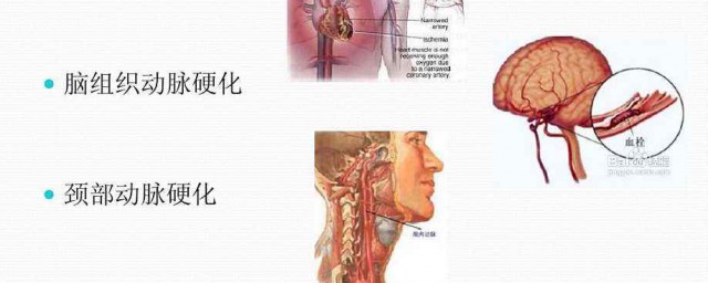 颈动脉堵塞处理方法(颈动脉堵塞的症状与解决方法)