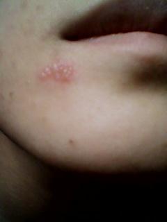 郑爽嘴角伤疤原因,郑爽嘴巴为什么(郑爽嘴唇上的疤) 郑爽嘴角伤疤原因,郑爽嘴巴为什么(郑爽嘴唇上的疤)