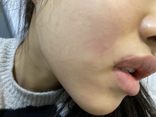 郑爽嘴角伤疤原因，郑爽嘴巴为什么(郑爽嘴唇上的疤)