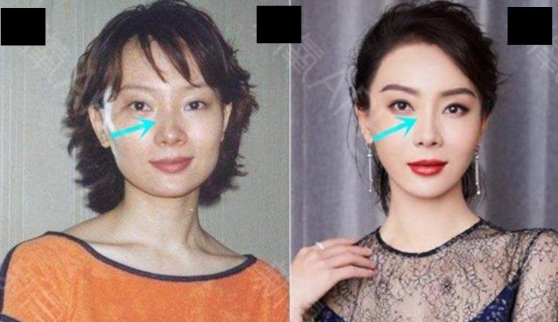 哪些女明星整过容，哪些明星整过容(明星整过容的都有哪些)