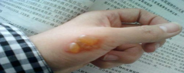 被水烫伤起泡不可以吃什么盘点(烫伤起水泡饮食要注意什么)