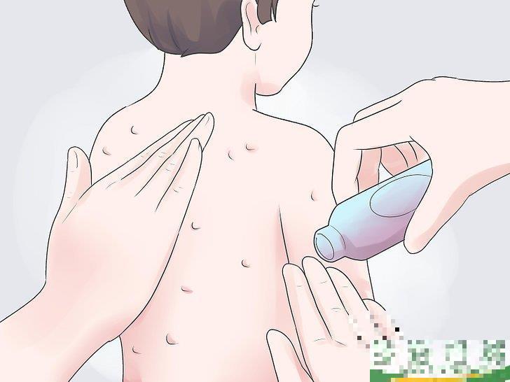 怎么自己在家治疗水痘(水痘在家治疗最佳方法)