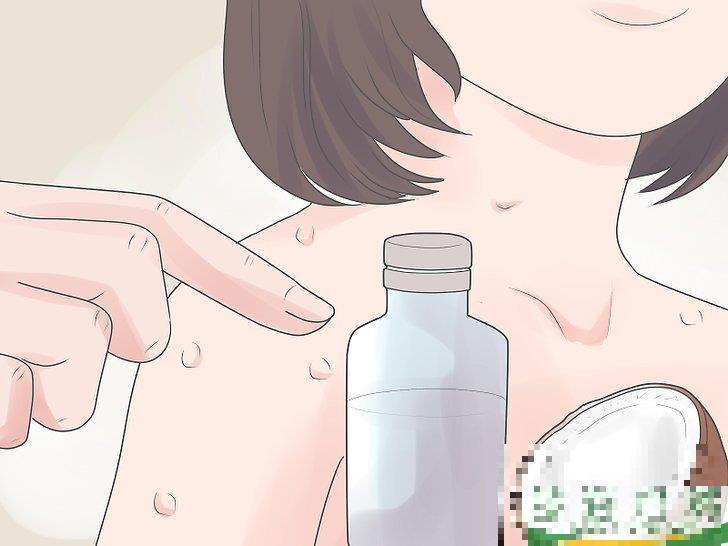 怎么自己在家治疗水痘(水痘在家治疗最佳方法)