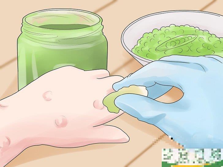 怎么自己在家治疗水痘(水痘在家治疗最佳方法)