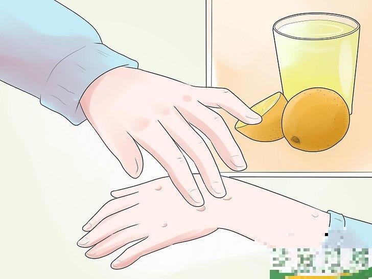 怎么自己在家治疗水痘(水痘在家治疗最佳方法)