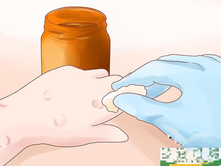 怎么自己在家治疗水痘(水痘在家治疗最佳方法)