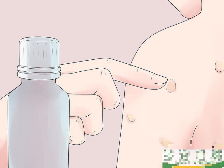 怎么自己在家治疗水痘(水痘在家治疗最佳方法)