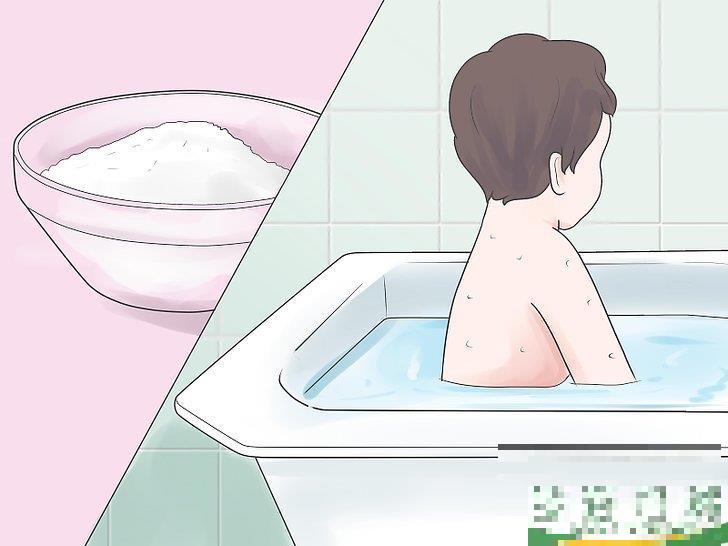 怎么自己在家治疗水痘(水痘在家治疗最佳方法)