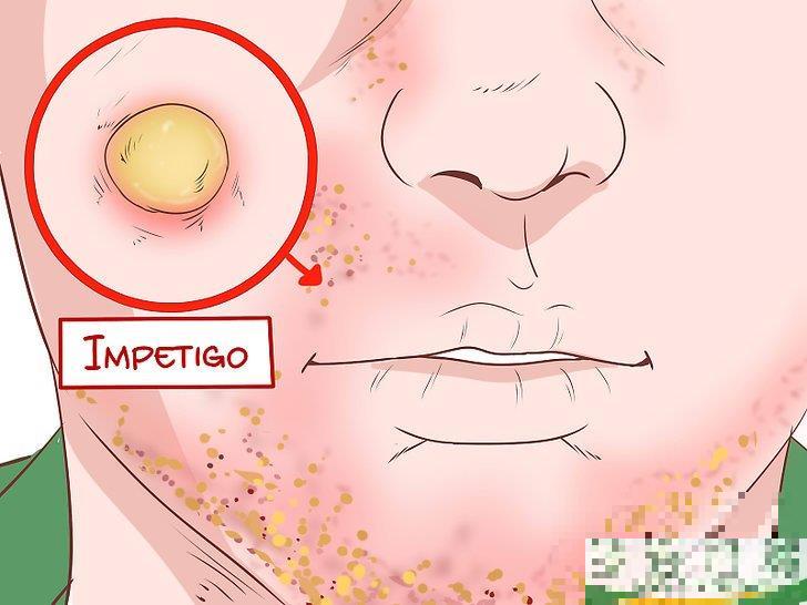怎么识别耐甲氧西林金黄色葡萄球菌(MRSA)的症状(耐甲氧西林的葡萄球菌(MRSA检测) 怎么识别耐甲氧西林金黄色葡萄球菌(MRSA)的症状(耐甲氧西林的葡萄球菌(MRSA检测)