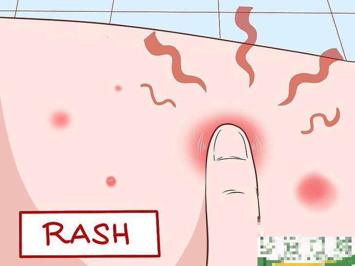 怎么识别耐甲氧西林金黄色葡萄球菌(MRSA)的症状(耐甲氧西林的葡萄球菌(MRSA检测) 怎么识别耐甲氧西林金黄色葡萄球菌(MRSA)的症状(耐甲氧西林的葡萄球菌(MRSA检测)