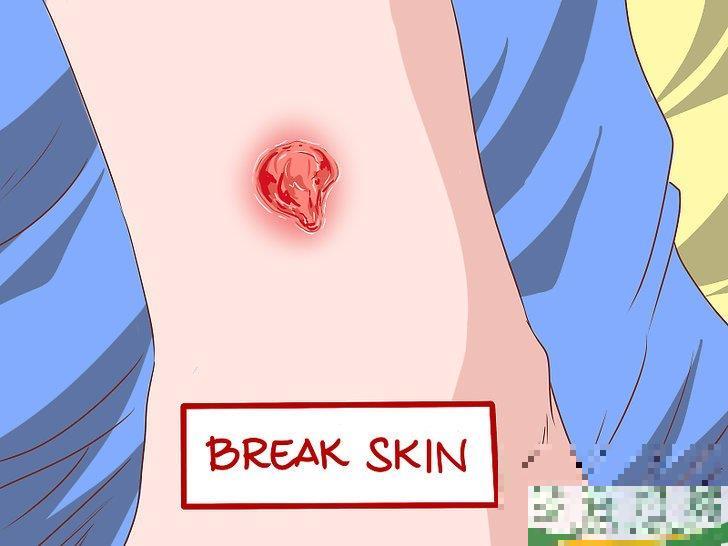 怎么识别耐甲氧西林金黄色葡萄球菌（MRSA）的症状(耐甲氧西林的葡萄球菌(MRSA检测)