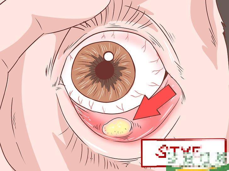 怎么识别耐甲氧西林金黄色葡萄球菌(MRSA)的症状(耐甲氧西林的葡萄球菌(MRSA检测) 怎么识别耐甲氧西林金黄色葡萄球菌(MRSA)的症状(耐甲氧西林的葡萄球菌(MRSA检测)