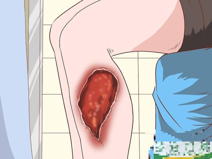 怎么识别耐甲氧西林金黄色葡萄球菌(MRSA)的症状(耐甲氧西林的葡萄球菌(MRSA检测) 怎么识别耐甲氧西林金黄色葡萄球菌(MRSA)的症状(耐甲氧西林的葡萄球菌(MRSA检测)