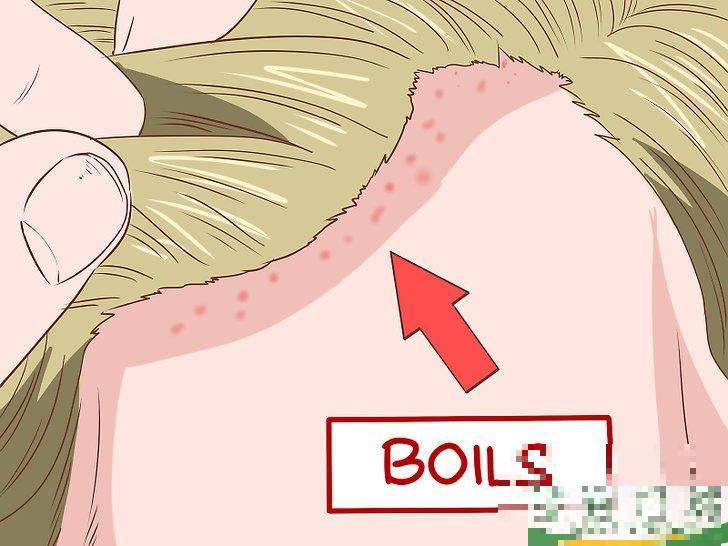 怎么识别耐甲氧西林金黄色葡萄球菌(MRSA)的症状(耐甲氧西林的葡萄球菌(MRSA检测) 怎么识别耐甲氧西林金黄色葡萄球菌(MRSA)的症状(耐甲氧西林的葡萄球菌(MRSA检测)