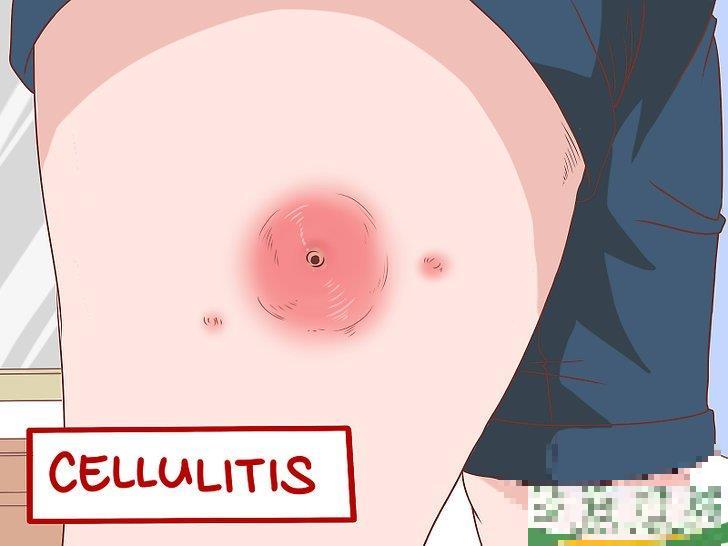 怎么识别耐甲氧西林金黄色葡萄球菌(MRSA)的症状(耐甲氧西林的葡萄球菌(MRSA检测) 怎么识别耐甲氧西林金黄色葡萄球菌(MRSA)的症状(耐甲氧西林的葡萄球菌(MRSA检测)