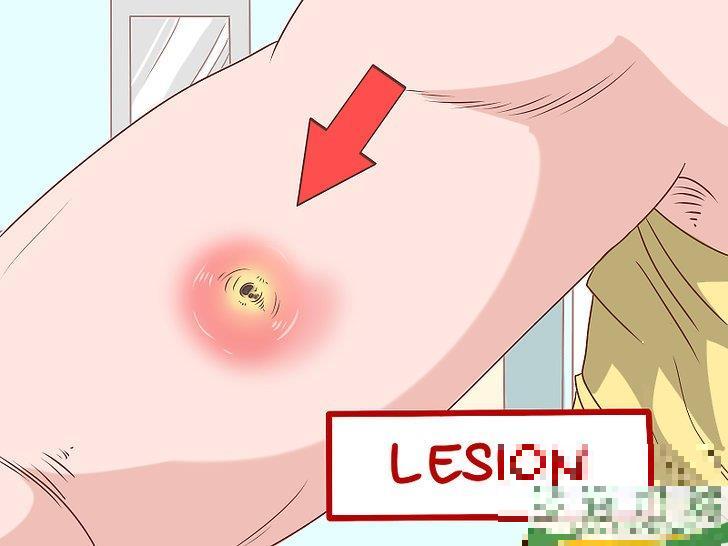 怎么识别耐甲氧西林金黄色葡萄球菌(MRSA)的症状(耐甲氧西林的葡萄球菌(MRSA检测) 怎么识别耐甲氧西林金黄色葡萄球菌(MRSA)的症状(耐甲氧西林的葡萄球菌(MRSA检测)