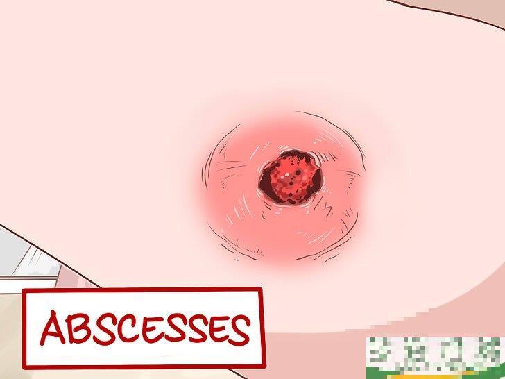 怎么识别耐甲氧西林金黄色葡萄球菌(MRSA)的症状(耐甲氧西林的葡萄球菌(MRSA检测) 怎么识别耐甲氧西林金黄色葡萄球菌(MRSA)的症状(耐甲氧西林的葡萄球菌(MRSA检测)