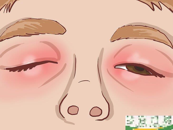 怎么治疗眼部周围的湿疹(眼周皮肤湿疹怎么办) 怎么治疗眼部周围的湿疹(眼周皮肤湿疹怎么办)