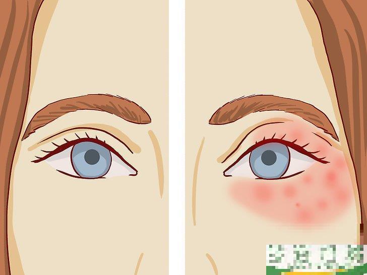 怎么治疗眼部周围的湿疹(眼周皮肤湿疹怎么办) 怎么治疗眼部周围的湿疹(眼周皮肤湿疹怎么办)