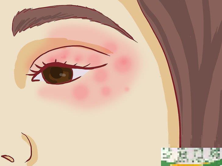 怎么治疗眼部周围的湿疹(眼周皮肤湿疹怎么办) 怎么治疗眼部周围的湿疹(眼周皮肤湿疹怎么办)