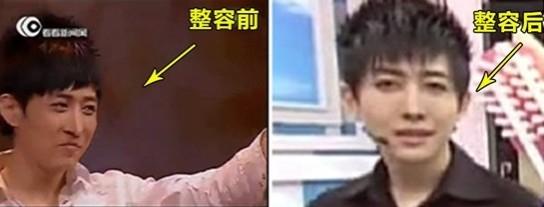 王亦丰整容,yif整容脸