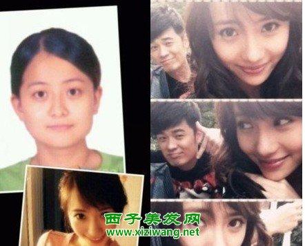 刘萌萌整容，张萌脸打很多玻尿酸(张萌整容记)