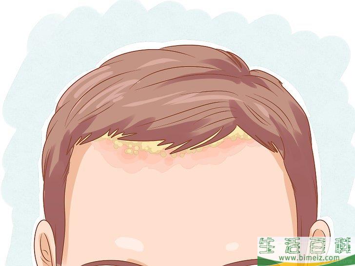 去除头皮屑小妙招(快速去除头皮屑小妙招) 去除头皮屑小妙招(快速去除头皮屑小妙招)